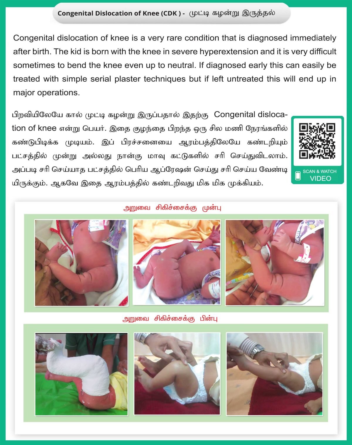 Congenital Dislocation of Knee